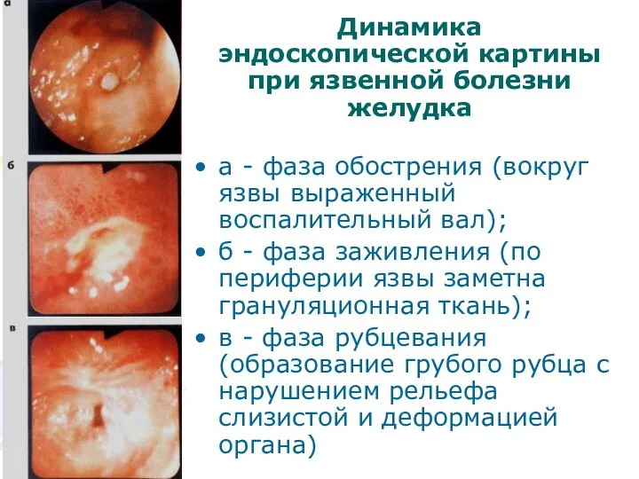 Динамика эндоскопической картины при язвенной болезни желудка а - фаза обострения (вокруг язвы
