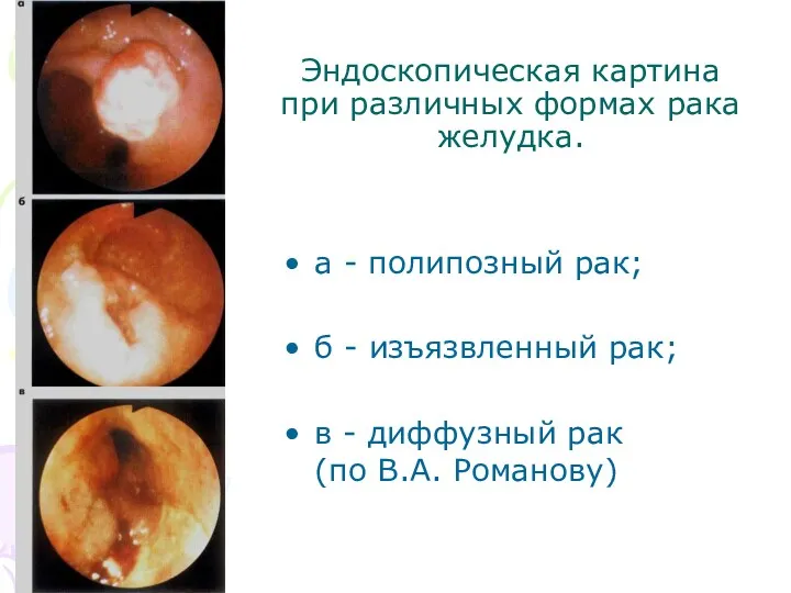 Эндоскопическая картина при различных формах рака желудка. а - полипозный рак; б -