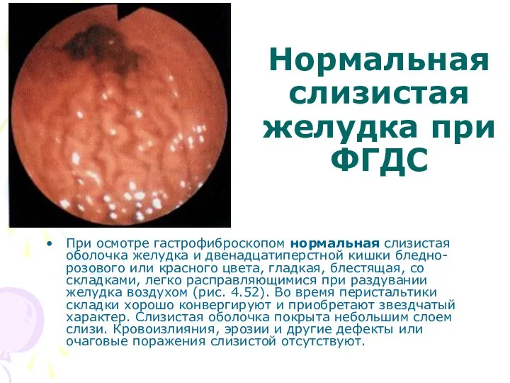 Нормальная слизистая желудка при ФГДС При осмотре гастрофиброскопом нормальная слизистая оболочка желудка и