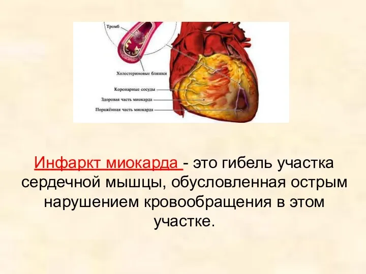 Инфаркт миокарда - это гибель участка сердечной мышцы, обусловленная острым нарушением кровообращения в этом участке.