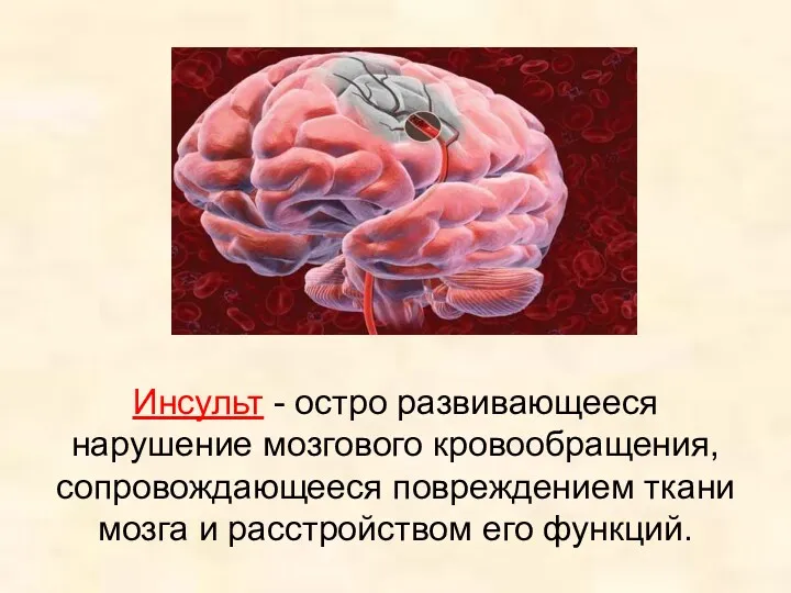 Инсульт - остро развивающееся нарушение мозгового кровообращения, сопровождающееся повреждением ткани мозга и расстройством его функций.