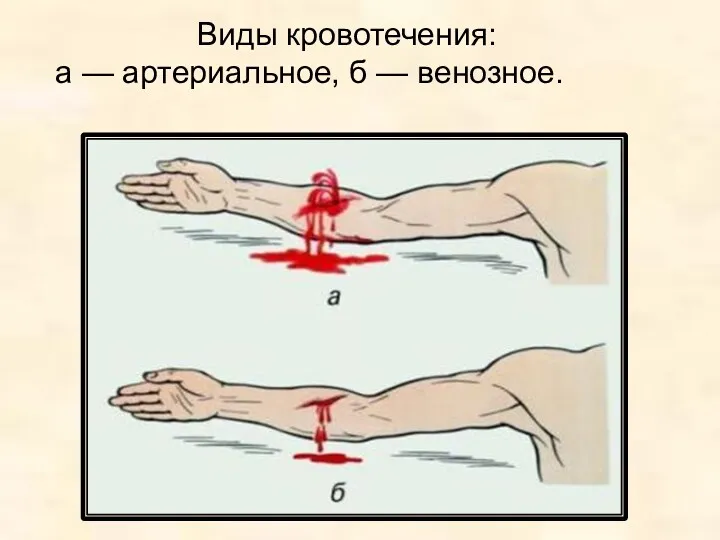 Виды кровотечения: а — артериальное, б — венозное.