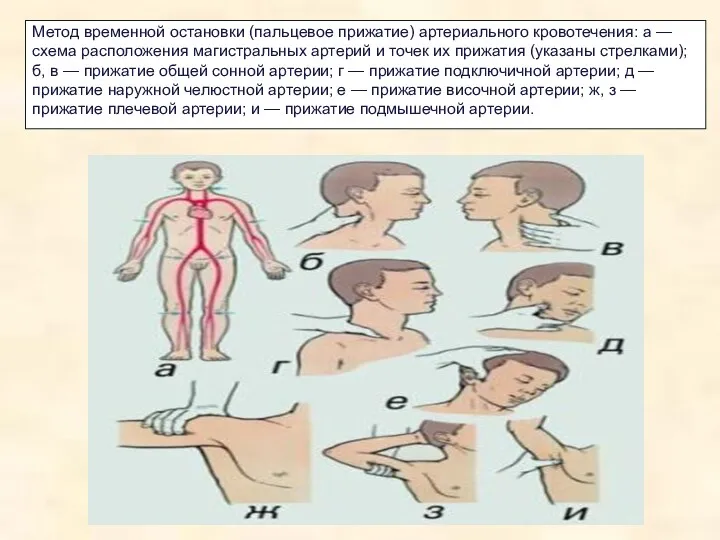 Метод временной остановки (пальцевое прижатие) артериального кровотечения: а — схема