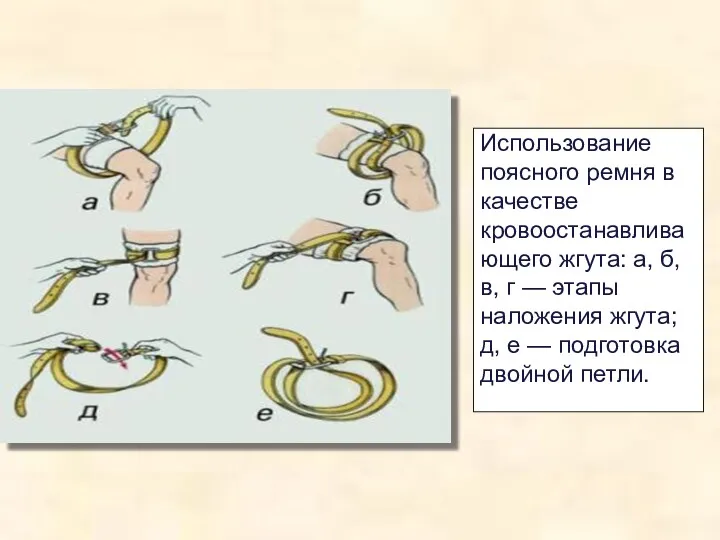 Использование поясного ремня в качестве кровоостанавливающего жгута: а, б, в,