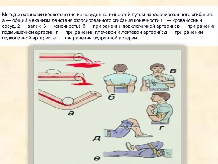 Методы остановки кровотечения из сосудов конечностей путем их форсированного сгибания: