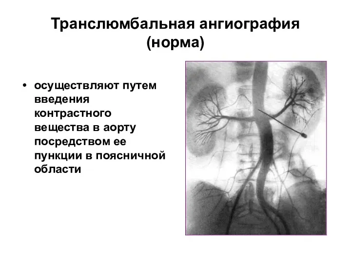 Транслюмбальная ангиография (норма) осуществляют путем введения контрастного вещества в аорту посредством ее пункции в поясничной области