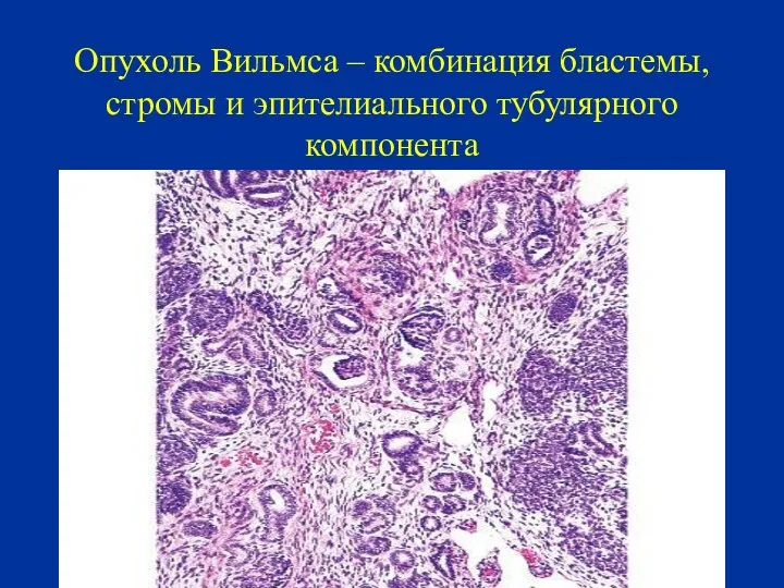 Опухоль Вильмса – комбинация бластемы, стромы и эпителиального тубулярного компонента