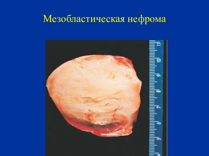 Мезобластическая нефрома