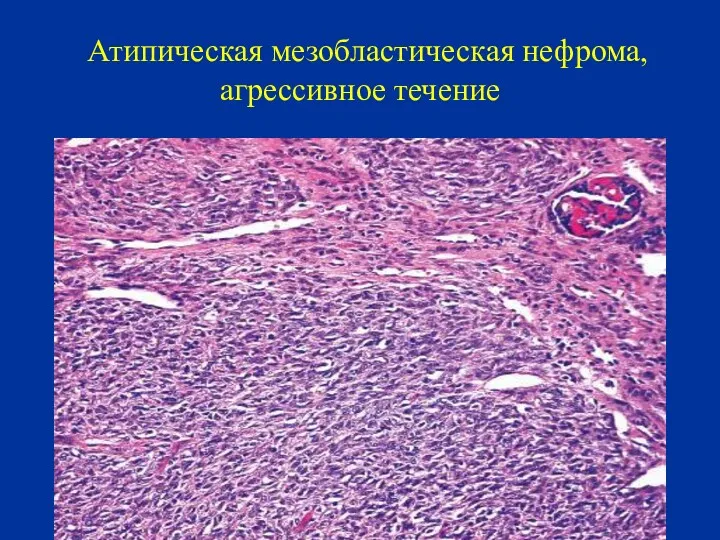 Атипическая мезобластическая нефрома, агрессивное течение