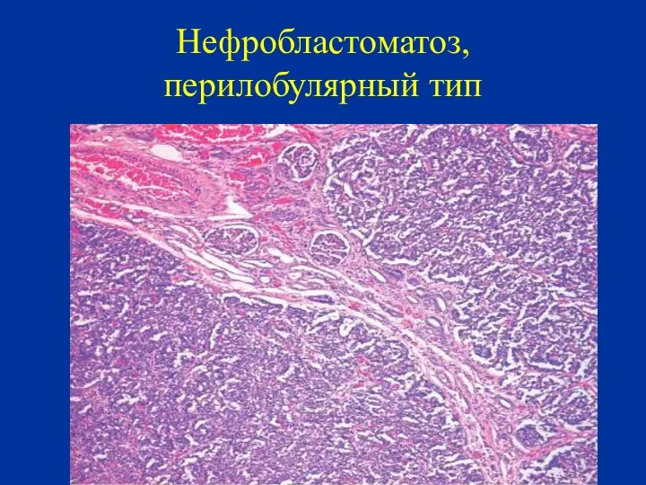 Нефробластоматоз, перилобулярный тип