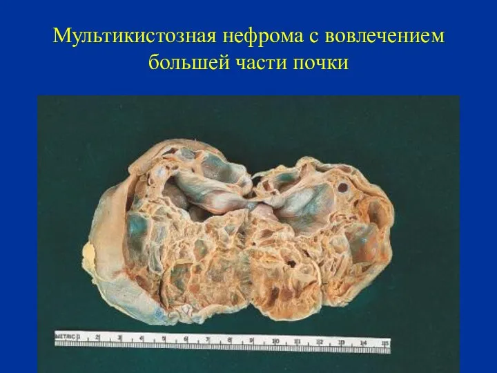 Мультикистозная нефрома с вовлечением большей части почки