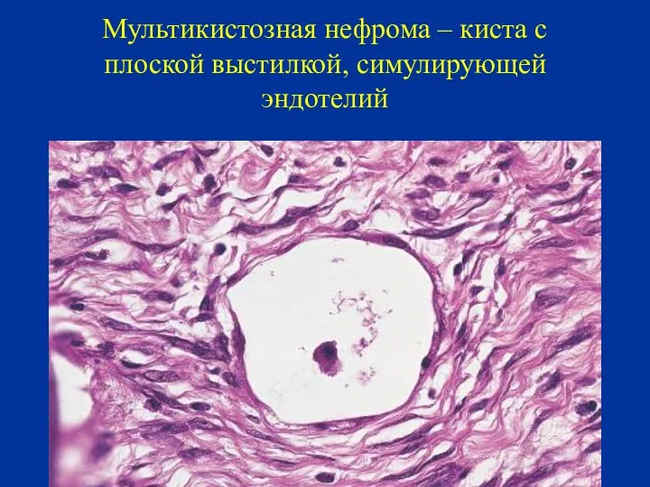 Мультикистозная нефрома – киста с плоской выстилкой, симулирующей эндотелий