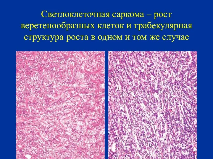 Светлоклеточная саркома – рост веретенообразных клеток и трабекулярная структура роста в одном и том же случае