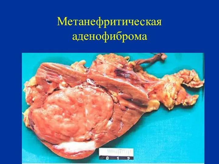 Метанефритическая аденофиброма