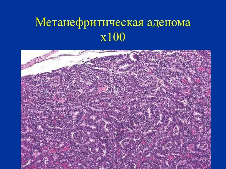 Метанефритическая аденома х100