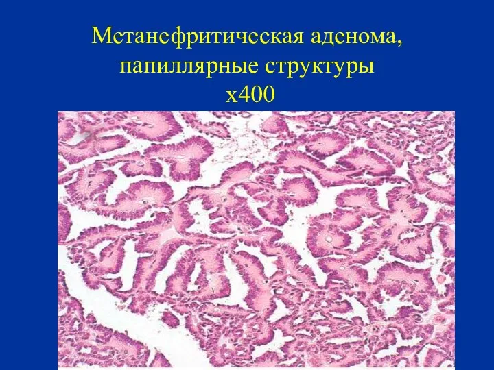 Метанефритическая аденома, папиллярные структуры х400