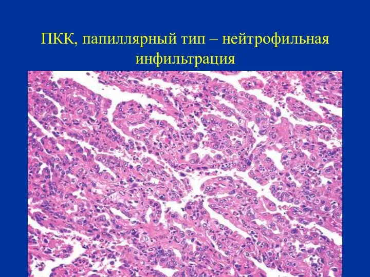 ПКК, папиллярный тип – нейтрофильная инфильтрация