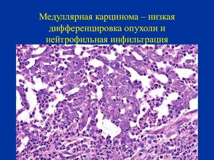 Медуллярная карцинома – низкая дифференцировка опухоли и нейтрофильная инфильтрация