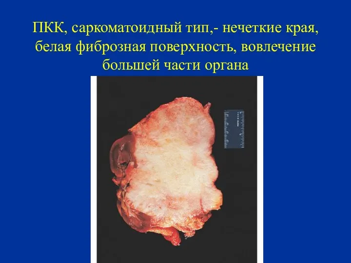 ПКК, саркоматоидный тип,- нечеткие края, белая фиброзная поверхность, вовлечение большей части органа