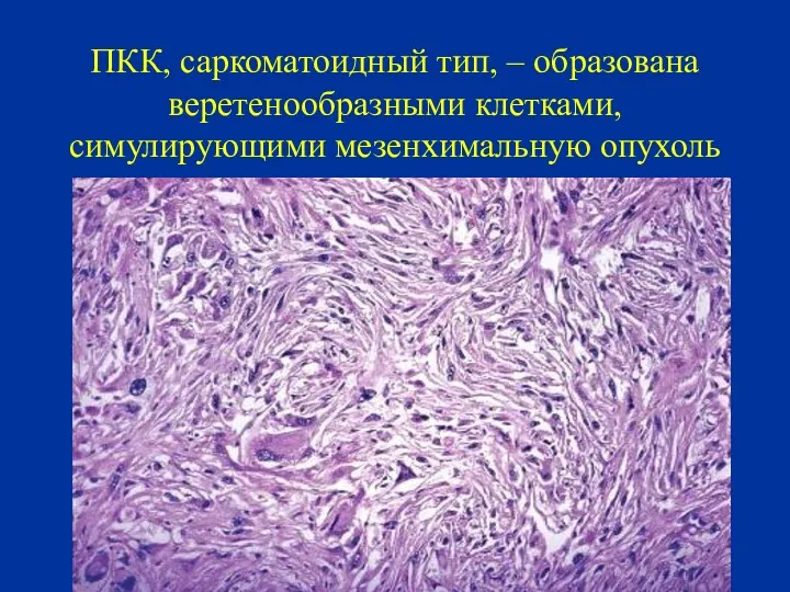 ПКК, саркоматоидный тип, – образована веретенообразными клетками, симулирующими мезенхимальную опухоль