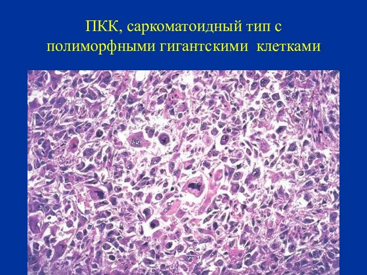 ПКК, саркоматоидный тип с полиморфными гигантскими клетками