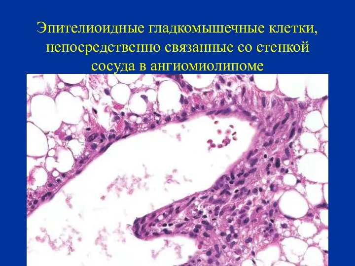 Эпителиоидные гладкомышечные клетки, непосредственно связанные со стенкой сосуда в ангиомиолипоме