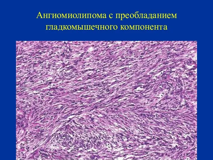 Ангиомиолипома с преобладанием гладкомышечного компонента