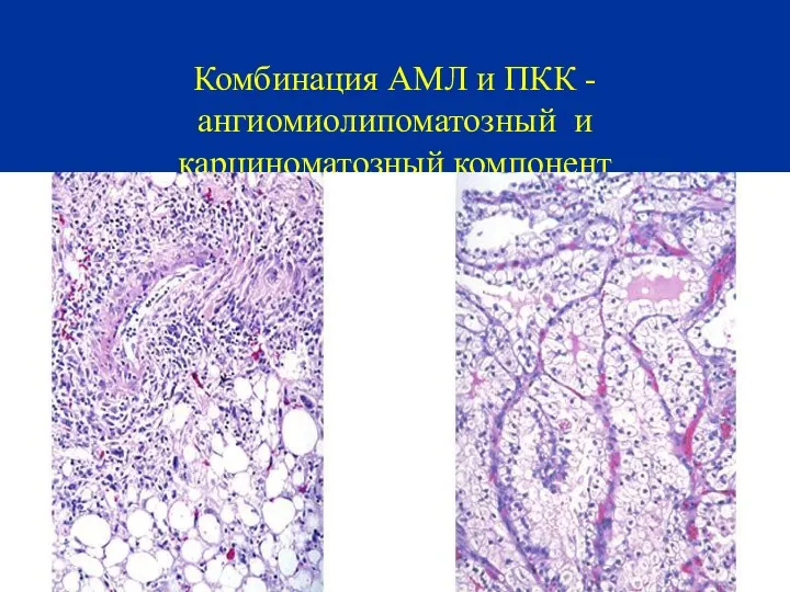 Комбинация АМЛ и ПКК - ангиомиолипоматозный и карциноматозный компонент