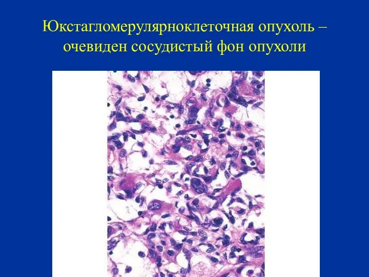 Юкстагломерулярноклеточная опухоль – очевиден сосудистый фон опухоли