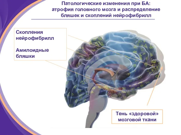 Патологические изменения при БА: атрофия головного мозга и распределение бляшек