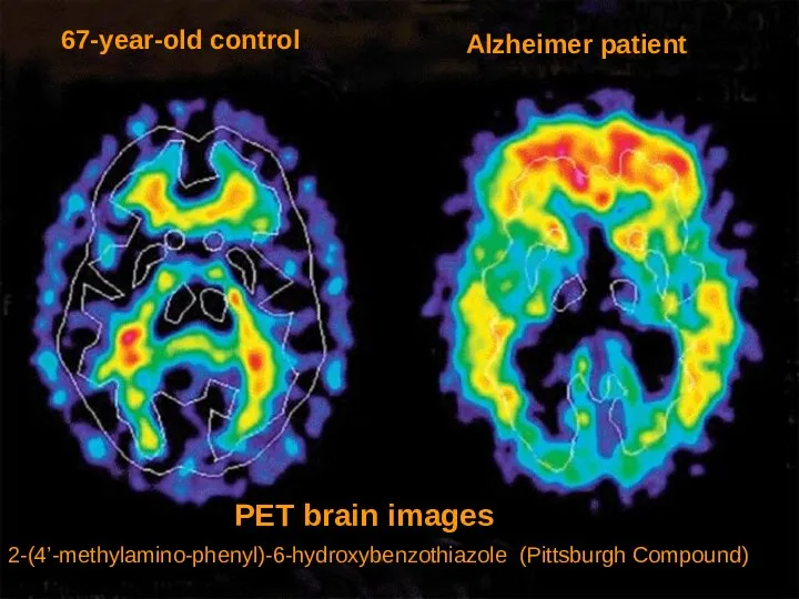 2-(4’-methylamino-phenyl)-6-hydroxybenzothiazole (Pittsburgh Compound) 67-year-old control Alzheimer patient PET brain images