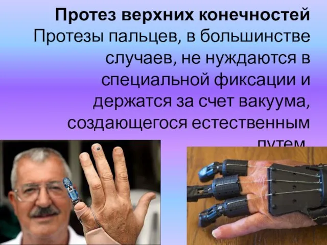 Протез верхних конечностей Протезы пальцев, в большинстве случаев, не нуждаются