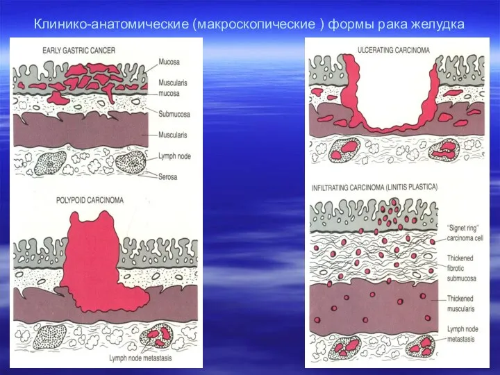 Клинико-анатомические (макроскопические ) формы рака желудка