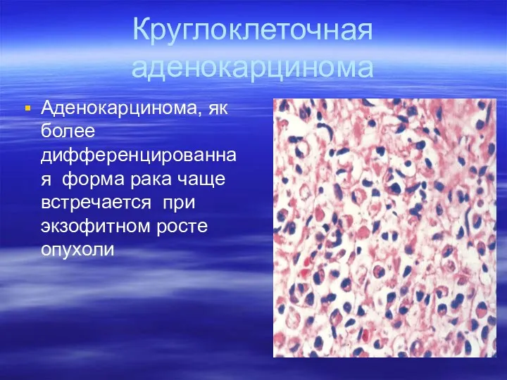 Круглоклеточная аденокарцинома Аденокарцинома, як более дифференцированная форма рака чаще встречается при экзофитном росте опухоли