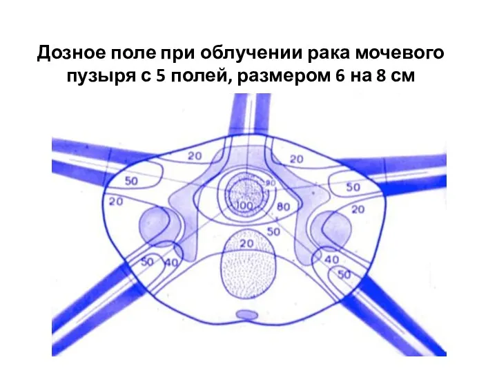 Дозное поле при облучении рака мочевого пузыря с 5 полей, размером 6 на 8 см