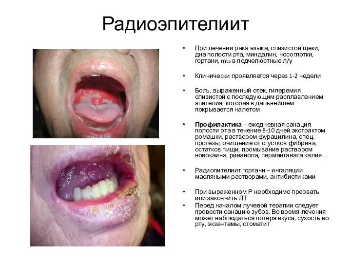 Радиоэпителиит При лечении рака языка, слизистой щеки, дна полости рта,