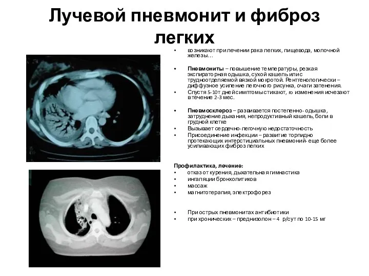 Лучевой пневмонит и фиброз легких возникают при лечении рака легких,