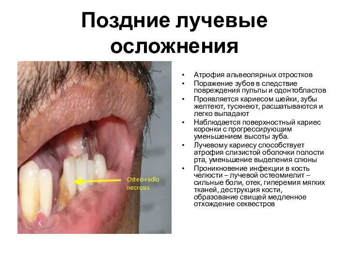 Поздние лучевые осложнения Атрофия альвеолярных отростков Поражение зубов в следствие