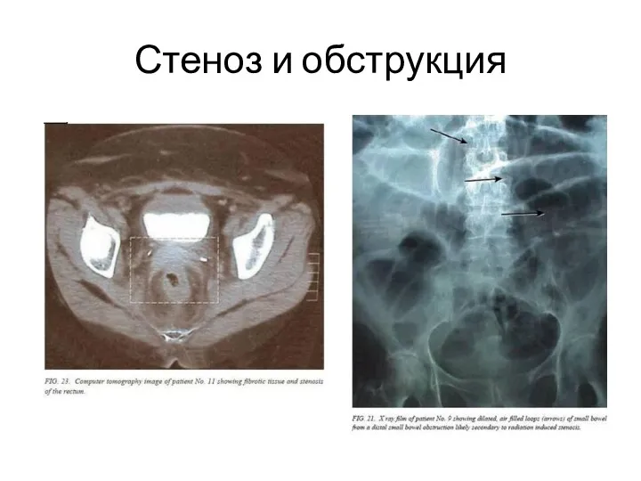 Стеноз и обструкция