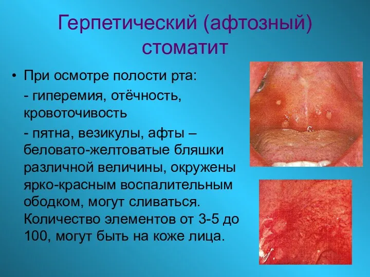 Герпетический (афтозный) стоматит При осмотре полости рта: - гиперемия, отёчность,