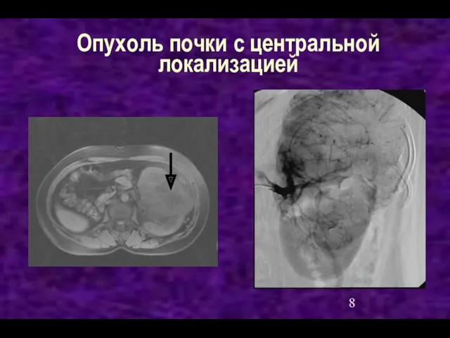 Опухоль почки с центральной локализацией