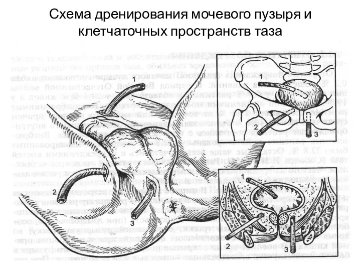 Схема дренирования мочевого пузыря и клетчаточных пространств таза