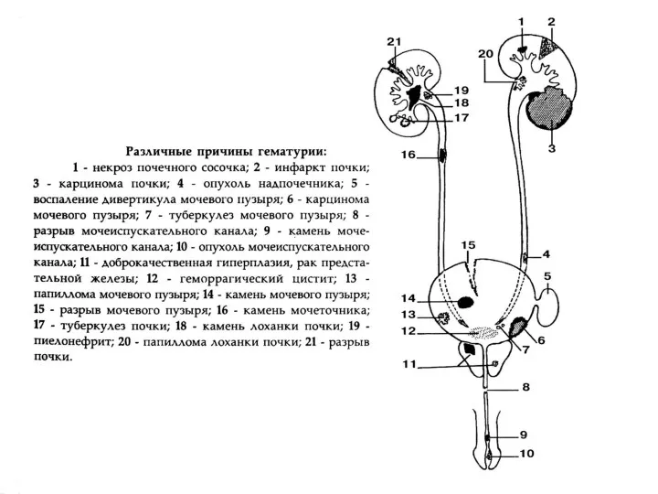 Причины гематурии