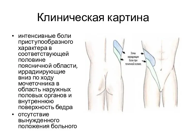 Клиническая картина интенсивные боли приступообразного характера в соответствующей половине поясничной