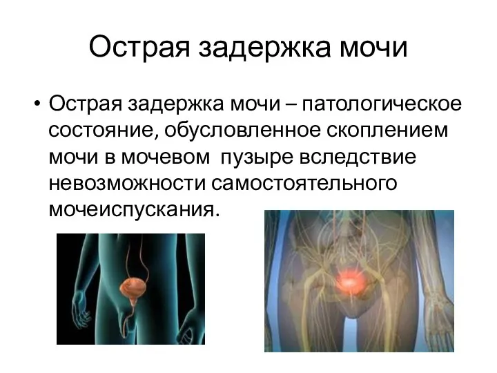 Острая задержка мочи Острая задержка мочи – патологическое состояние, обусловленное