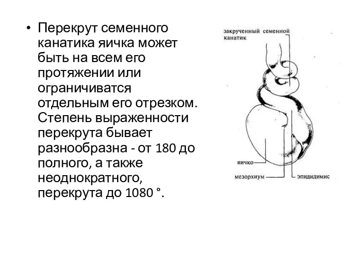 Перекрут семенного канатика яичка может быть на всем его протяжении