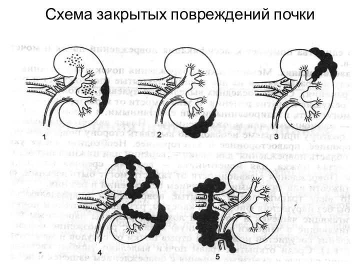 Схема закрытых повреждений почки