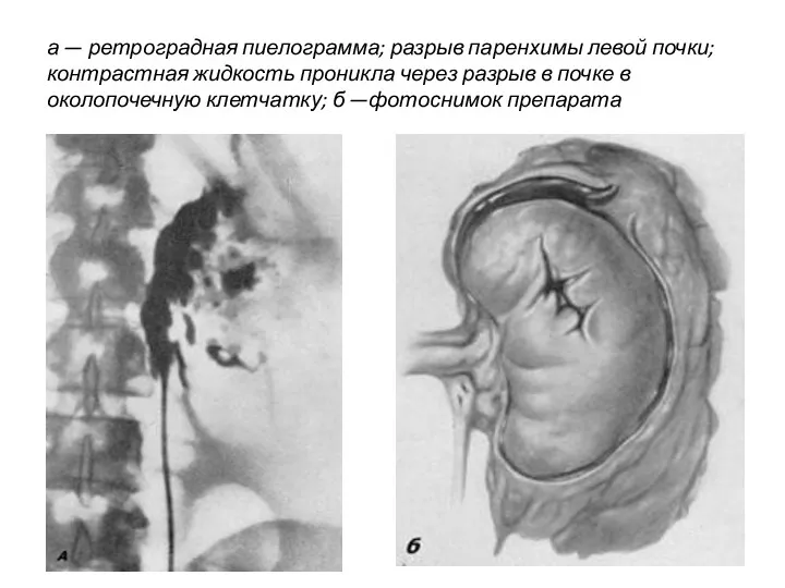 а — ретроградная пиелограмма; разрыв паренхимы левой почки; контрастная жидкость