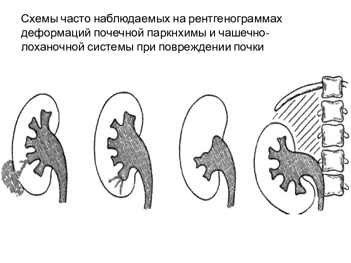 Схемы часто наблюдаемых на рентгенограммах деформаций почечной паркнхимы и чашечно-лоханочной системы при повреждении почки