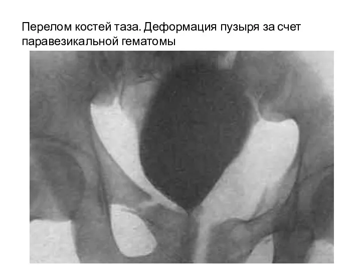 Перелом костей таза. Деформация пузыря за счет паравезикальной гематомы